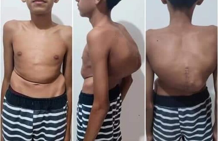 Família de menino com coluna que ultrapassa 100 graus de curvatura luta por cirurgia: ‘Correndo contra o tempo’ | Bauru e Marília