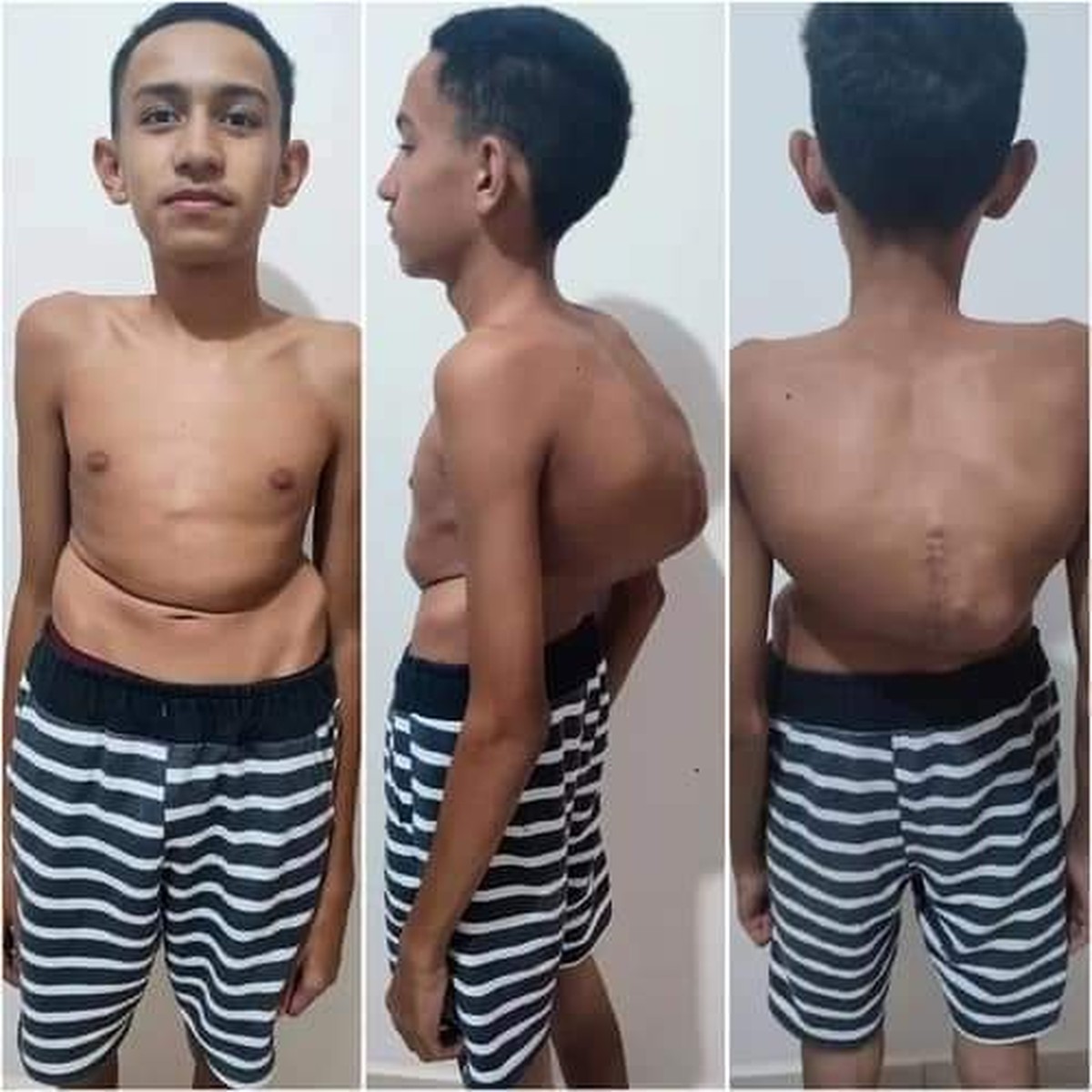 Família de menino com coluna que ultrapassa 100 graus de curvatura luta por cirurgia: ‘Correndo contra o tempo’ | Bauru e Marília