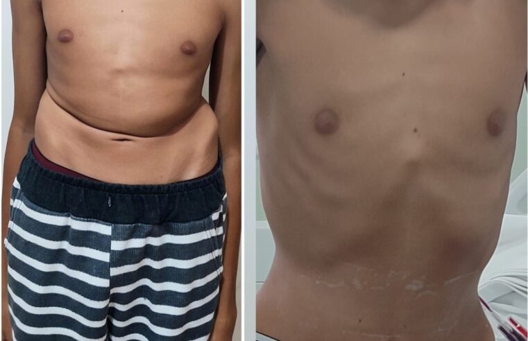 Adolescente com coluna que ultrapassava 100 graus de curvatura passa por cirurgia: 'Recomeço', diz mãe